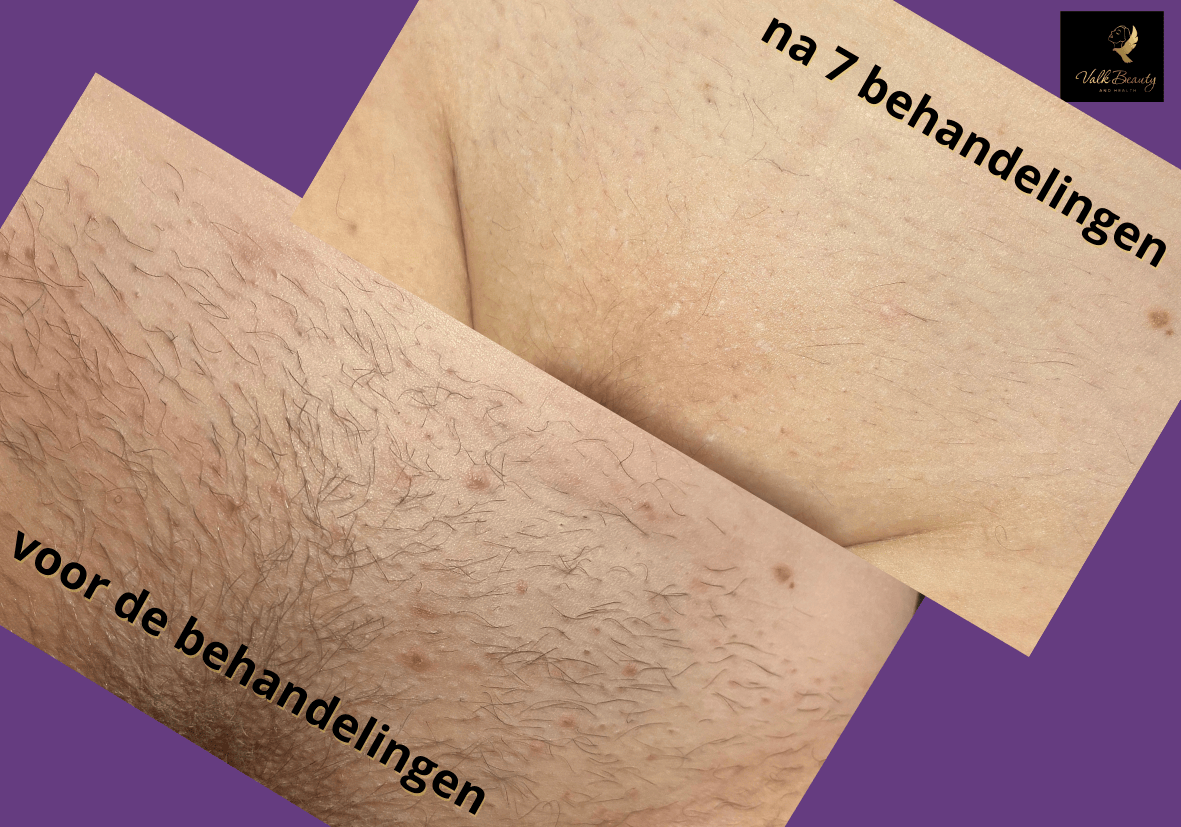 voor de behandelingen 10 x 7 cm 2